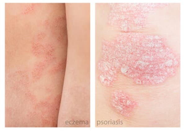 Is It Psoriasis Or Eczema Alamo Heights Dermatology