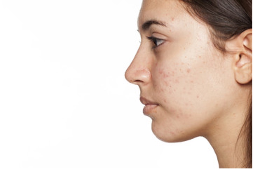 Side profile image of a young woman with facial acne.