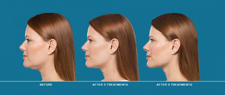kybella double chin dermatology alamo heights san antonio texas