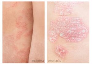 Photo displaying eczema and psoriasis side by side.