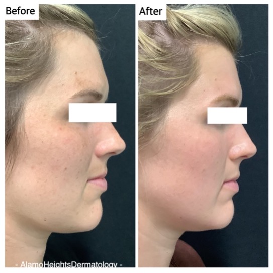 Before and after image of dark spot removal