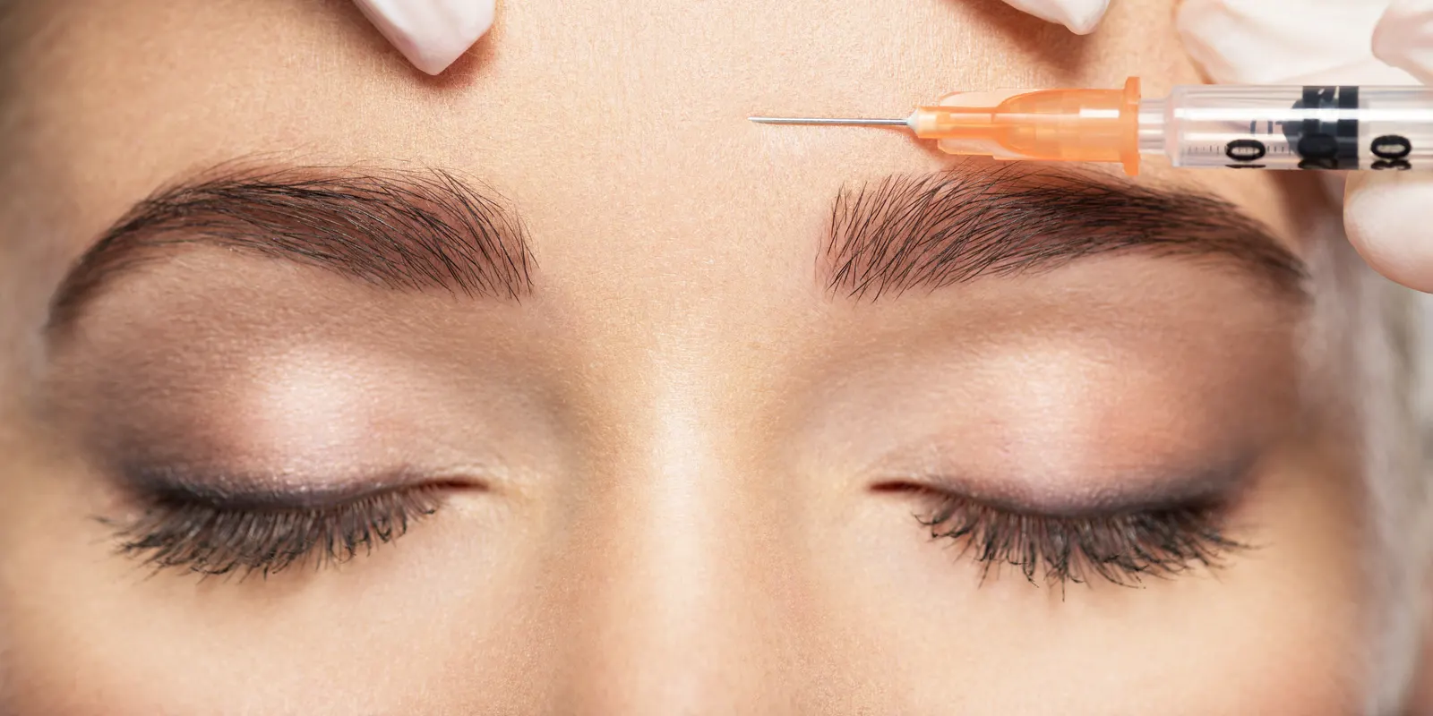 Neuromodulator injection between the eyebrows to smooth frown lines